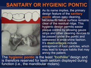 As its name implies, the primary
design feature of the sanitary
pontic allows easy cleaning,
because its tissue surface remains
clear of the residual ridge. This
hygienic design permits easier
plaque control by allowing gauze
strips and other cleaning devices to
be passed under the pontic and
seesawed in shoe-shine fashion.
It’s disadvantages include
entrapment of food particles, which
may lead to tongue habits that may
annoy the patient.
SANITARY OR HYGIENIC PONTIC
The hygienic pontic is the least “toothlike” design and
is therefore reserved for teeth seldom displayed during
function (i.e., the mandibular molars).
 