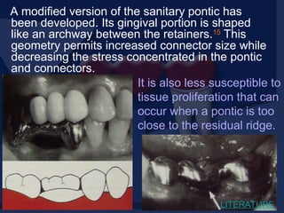 A modified version of the sanitary pontic has
been developed. Its gingival portion is shaped
like an archway between the retainers.15
This
geometry permits increased connector size while
decreasing the stress concentrated in the pontic
and connectors.
It is also less susceptible to
tissue proliferation that can
occur when a pontic is too
close to the residual ridge.
LITERATURE
 