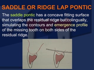 The saddle pontic has a concave fitting surface
that overlaps the residual ridge buccolingually,
simulating the contours and emergence profile
of the missing tooth on both sides of the
residual ridge.
SADDLE OR RIDGE LAP PONTIC
 