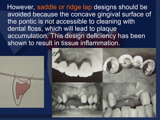 However, saddle or ridge lap designs should be
avoided because the concave gingival surface of
the pontic is not accessible to cleaning with
dental floss, which will lead to plaque
accumulation. This design deficiency has been
shown to result in tissue inflammation.
 