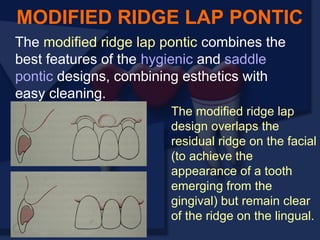 The modified ridge lap pontic combines the
best features of the hygienic and saddle
pontic designs, combining esthetics with
easy cleaning.
MODIFIED RIDGE LAP PONTIC
The modified ridge lap
design overlaps the
residual ridge on the facial
(to achieve the
appearance of a tooth
emerging from the
gingival) but remain clear
of the ridge on the lingual.
 