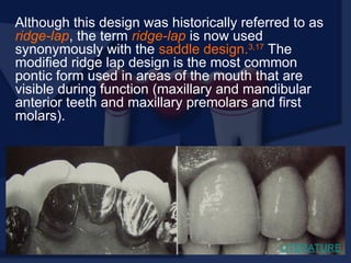Although this design was historically referred to as
ridge-lap, the term ridge-lap is now used
synonymously with the saddle design.3,17
The
modified ridge lap design is the most common
pontic form used in areas of the mouth that are
visible during function (maxillary and mandibular
anterior teeth and maxillary premolars and first
molars).
LITERATURE
 