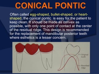 Often called egg-shaped, bullet-shaped, or heart-
shaped, the conical pontic is easy for the patient to
keep clean. It should be made as convex as
possible, with only one point of contact at the center
of the residual ridge. This design is recommended
for the replacement of mandibular posterior teeth
where esthetics is a lesser concern.
CONICAL PONTIC
 