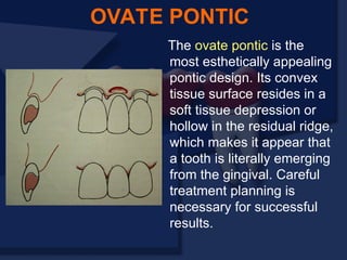 The ovate pontic is the
most esthetically appealing
pontic design. Its convex
tissue surface resides in a
soft tissue depression or
hollow in the residual ridge,
which makes it appear that
a tooth is literally emerging
from the gingival. Careful
treatment planning is
necessary for successful
results.
OVATE PONTIC
 