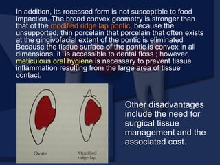 In addition, its recessed form is not susceptible to food
impaction. The broad convex geometry is stronger than
that of the modified ridge lap pontic, because the
unsupported, thin porcelain that porcelain that often exists
at the gingivofacial extent of the pontic is eliminated
Because the tissue surface of the pontic is convex in all
dimensions, it is accessible to dental floss ; however,
meticulous oral hygiene is necessary to prevent tissue
inflammation resulting from the large area of tissue
contact.
Other disadvantages
include the need for
surgical tissue
management and the
associated cost.
 