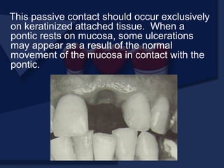 This passive contact should occur exclusively
on keratinized attached tissue. When a
pontic rests on mucosa, some ulcerations
may appear as a result of the normal
movement of the mucosa in contact with the
pontic.
 