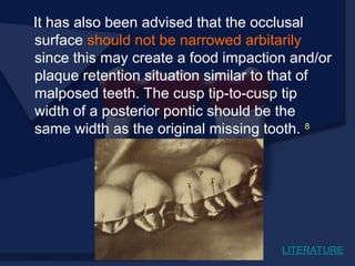 It has also been advised that the occlusal
surface should not be narrowed arbitarily
since this may create a food impaction and/or
plaque retention situation similar to that of
malposed teeth. The cusp tip-to-cusp tip
width of a posterior pontic should be the
same width as the original missing tooth. 8
LITERATURE
 