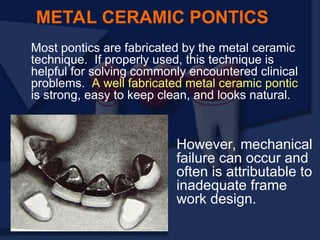 Most pontics are fabricated by the metal ceramic
technique. If properly used, this technique is
helpful for solving commonly encountered clinical
problems. A well fabricated metal ceramic pontic
is strong, easy to keep clean, and looks natural.
METAL CERAMIC PONTICS
However, mechanical
failure can occur and
often is attributable to
inadequate frame
work design.
 