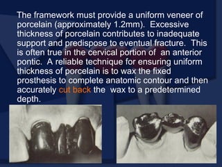 The framework must provide a uniform veneer of
porcelain (approximately 1.2mm). Excessive
thickness of porcelain contributes to inadequate
support and predispose to eventual fracture. This
is often true in the cervical portion of an anterior
pontic. A reliable technique for ensuring uniform
thickness of porcelain is to wax the fixed
prosthesis to complete anatomic contour and then
accurately cut back the wax to a predetermined
depth.
 