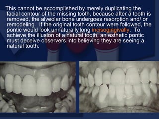 This cannot be accomplished by merely duplicating the
facial contour of the missing tooth, because after a tooth is
removed, the alveolar bone undergoes resorption and/ or
remodeling. If the original tooth contour were followed, the
pontic would look unnaturally long incisogingivally. To
achieve the illusion of a natural tooth, an esthetic pontic
must deceive observers into believing they are seeing a
natural tooth.
 