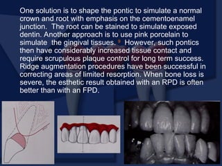One solution is to shape the pontic to simulate a normal
crown and root with emphasis on the cementoenamel
junction. The root can be stained to simulate exposed
dentin. Another approach is to use pink porcelain to
simulate the gingival tissues. 9
However, such pontics
then have considerably increased tissue contact and
require scrupulous plaque control for long term success.
Ridge augmentation procedures have been successful in
correcting areas of limited resorption. When bone loss is
severe, the esthetic result obtained with an RPD is often
better than with an FPD.
 
