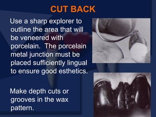 Use a sharp explorer to
outline the area that will
be veneered with
porcelain. The porcelain
metal junction must be
placed sufficiently lingual
to ensure good esthetics.
Make depth cuts or
grooves in the wax
pattern.
CUT BACK
 