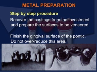 Step by step procedure
Recover the castings from the investment
and prepare the surfaces to be veneered
Finish the gingival surface of the pontic.
Do not over-reduce this area.
METAL PREPARATION
 