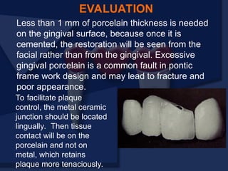 EVALUATION
Less than 1 mm of porcelain thickness is needed
on the gingival surface, because once it is
cemented, the restoration will be seen from the
facial rather than from the gingival. Excessive
gingival porcelain is a common fault in pontic
frame work design and may lead to fracture and
poor appearance.
To facilitate plaque
control, the metal ceramic
junction should be located
lingually. Then tissue
contact will be on the
porcelain and not on
metal, which retains
plaque more tenaciously.
 