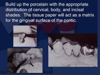 Build up the porcelain with the appropriate
distribution of cervical, body, and incisal
shades. The tissue paper will act as a matrix
for the gingival surface of the pontic.
 