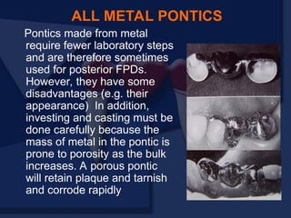 Pontics made from metal
require fewer laboratory steps
and are therefore sometimes
used for posterior FPDs.
However, they have some
disadvantages (e.g. their
appearance) In addition,
investing and casting must be
done carefully because the
mass of metal in the pontic is
prone to porosity as the bulk
increases. A porous pontic
will retain plaque and tarnish
and corrode rapidly
ALL METAL PONTICS
 