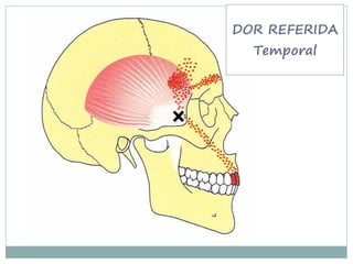 DOR REFERIDA
  Temporal
 