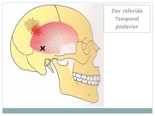 Dor referida
 Temporal
 posterior
 