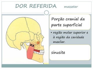 DOR REFERIDA      masseter



          Porção cranial da
          parte superficial
          • região molar superior e
           à região da cavidade
           maxilar.


          sinusite
 