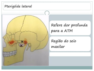 Pterigóide lateral




                     Refere dor profunda
                     para a ATM

                     Região do seio
                     maxilar
 