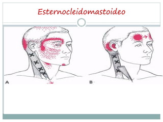 Esternocleidomastoideo
 