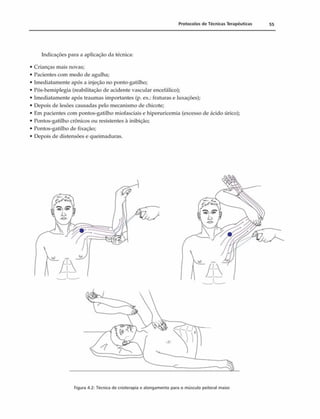 Protocolos de Técnicas Terapêuticas 55
Indicações paro a aplicação da técnica:
• Crianças mais novas;
• Pacientes com medo dc agulha;
• Imediatamente após a injeção no ponto-gatilho;
• Pós-hemiplegia (reabilitação de acidente vascular encefálico);
• Imediatamente após traumas importantes (p. ex.: fraturas e luxações);
• Depois de lesões causadas pelo mecanismo de chicote;
• F.m pacientes com pontos-gatilho miofasciais e hiperuricemia (excesso de ácido úrico);
• Pontos-gatilho crônicos ou resistentes à inibição;
• Pontos-gatilho de fixação;
• Depois de distensões e queimaduras.
Figura 4.2: Técnica de cnoterapia e alongamento para o músculo peitoral maior.
 