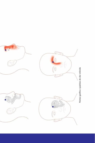 Pontos-gatilho
e
padrões
d
e
dor
referida
 