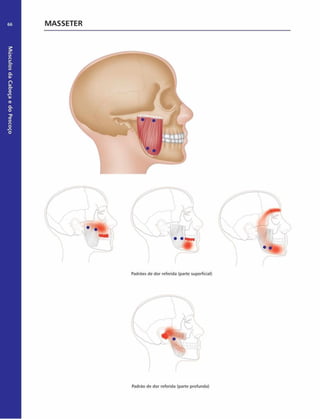Músculos
da
Cabeça
e
do
Pescoço
66 MASSETER
Padrões de dor referida (parte superficial)
Padrão de dor referida (parte profunda)
 