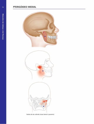 Músculos
da
Cabeça
e
do
Pescoço
72 PTERIGÓIDEO MEDIAL
Padrão de dor referida (vistas lateral e posterior)
 