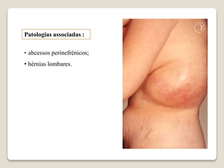 Patologias associadas :
• abcessos perinefrénicos;
• hérnias lombares.
 