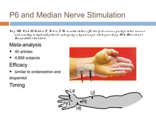 P6 and Median Nerve Stimulation
Fre y UH, Funk M, Lo hle in C, Pe te rs J. P6 acustim ulatio n e ffe ctive ly de cre ase s po sto pe rative nause a
and vo m iting in hig h-risk patie nts unde rg o ing a laparo sco pic cho le cyse cto m y. Acta Anae ste sio l
Scand 20 0 9 ; 1 0 2: 6 20 -5
Meta-analysis
• 40 articles
• 4,858 subjects
Efficacy
• similar to ondansetron and
droperidol
Timing
 