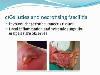 c)Celluties and necrotising fascilitis
 Involves deeper subcutaneous tissues
 Local inflammation and systemic sings like
ersipelas are observes
 