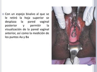  Con un espejo bivalvo al que se
le retiró la hoja superior se
desplaza la pared vaginal
posterior y permitir la
visualización de la pared vaginal
anterior, así como la medición de
los puntos Aa y Ba
 