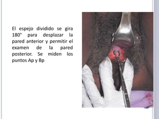 El espejo dividido se gira
180° para desplazar la
pared anterior y permitir el
examen de la pared
posterior. Se miden los
puntos Ap y Bp
 