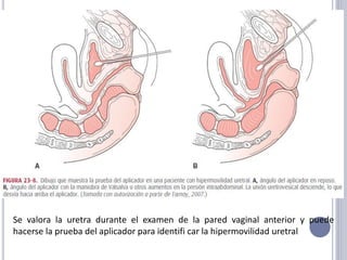 Se valora la uretra durante el examen de la pared vaginal anterior y puede
hacerse la prueba del aplicador para identifi car la hipermovilidad uretral
 