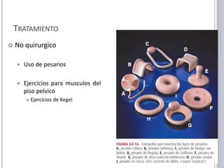 TRATAMIENTO
 No quirurgico
 Uso de pesarios
 Ejercicios para musculos del
piso pelvico
 Ejercicios de Kegel
 