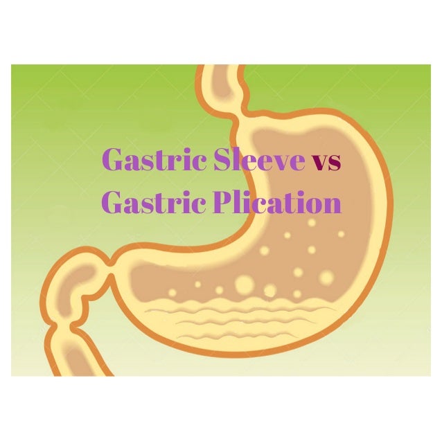 Gastric Sleeve vs Gastric Plication