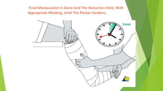 Final Manipulation Is Done And The Reduction Held, With
Appropriate Molding, Until The Plaster Hardens.
 