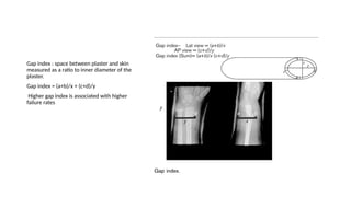 pop and casting techniques, basis of casting techniques | PPTX