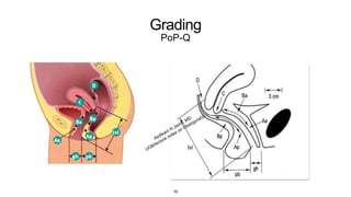 Grading
PoP-Q
16
 