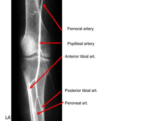 LATERAL
Femoral artery
Popliteal artery
Anterior tibial art.
Posterior tibial art.
Peroneal art.
 