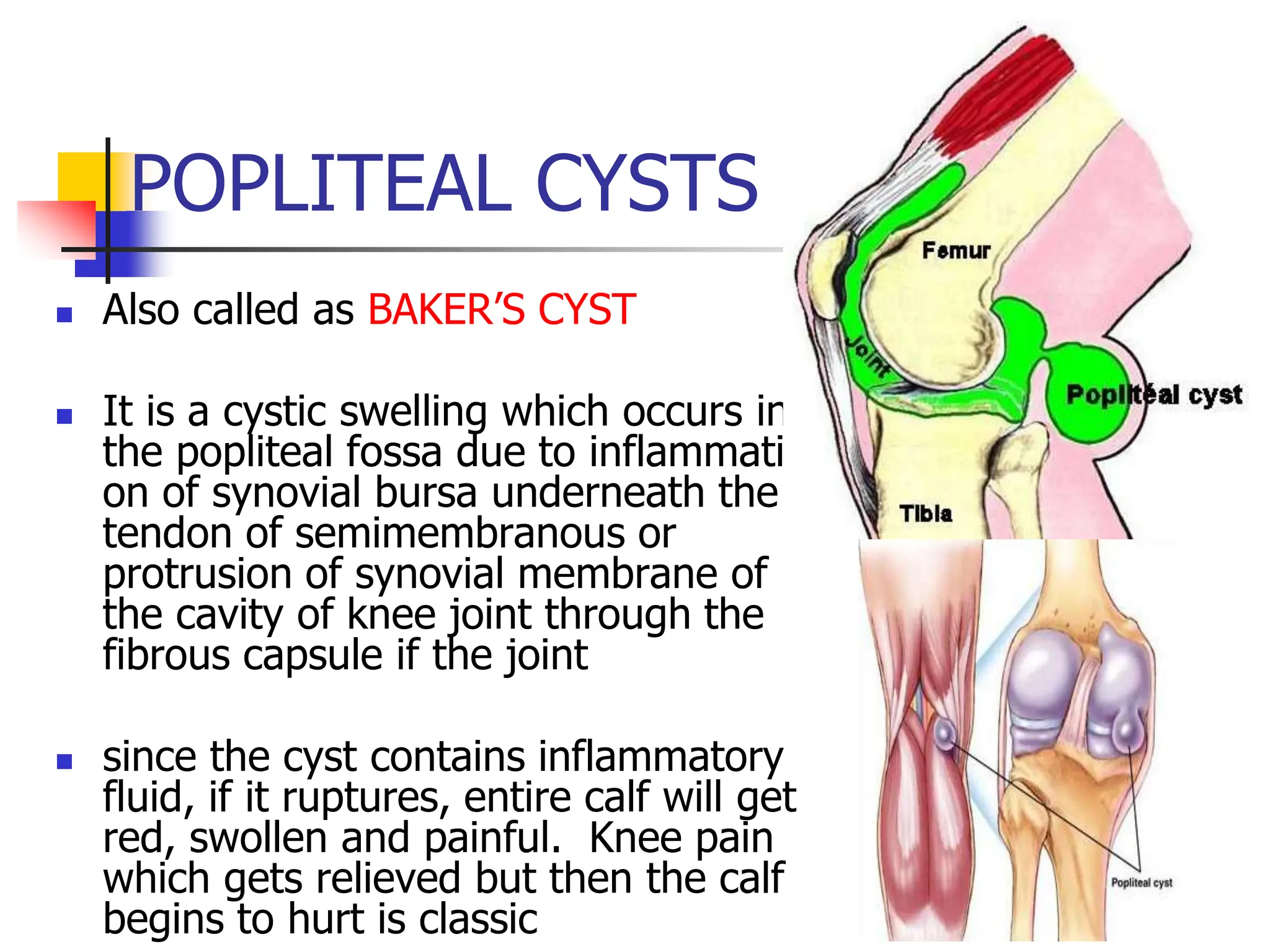 POPLITEAL CYSTS
 Also called as BAKER’S CYST
 It is a cystic swelling which occurs in
the popliteal fossa due to inflammation
on of synovial bursa underneath the
tendon of semimembranous or
protrusion of synovial membrane of
the cavity of knee joint through the
fibrous capsule if the joint
 since the cyst contains inflammatory
fluid, if it ruptures, entire calf will get
red, swollen and painful. Knee pain
which gets relieved but then the calf
begins to hurt is classic
 