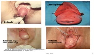  
Osama	
  	
  Warda	
   21	
  
Cystocele
Rectocele (high=
intact peineal body)
Rectocele
(low=peineal tear)
Uterine prolapse
 
