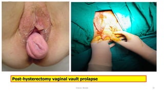  
Osama	
  	
  Warda	
   22	
  
Post-hysterectomy vaginal vault prolapse
 
