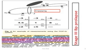  
Stage	
  III	
  Bp	
  prolapse	
  
31	
  
ß	
  Hymenal	
  ring	
  
Osama	
  	
  Warda	
  
 