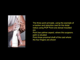 The three point principle, using the example of
a traction and reduction cast for the distal
radius using POP Point one dorsal moulded
rim
Point two palmar aspect, where the surgeons
palm is situated
Point three proximal shaft of the cast where
the four fingers are shown
 