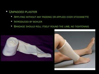 • UNPADDED PLASTER
• APPLYING WITHOUT ANY PADDING OR APPLIED OVER STOCKINETTE
• INTRODUCED BY BOHLER
• BANDAGE SHOULD ROLL ITSELF ROUND THE LIMB, NO TIGHTENINIG
 