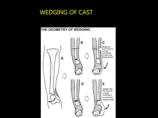 WEDGING OF CAST
 