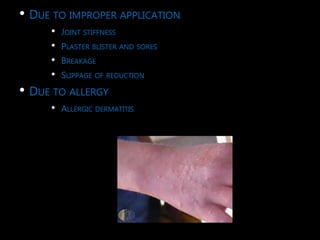 • DUE TO IMPROPER APPLICATION
• JOINT STIFFNESS
• PLASTER BLISTER AND SORES
• BREAKAGE
• SLIPPAGE OF REDUCTION
• DUE TO ALLERGY
• ALLERGIC DERMATITIS
 