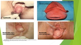 Cystocele
Uterine prolapse
Osama Warda 20
Rectocele (high=
intact peineal body)
Rectocele
(low=peineal tear)
 